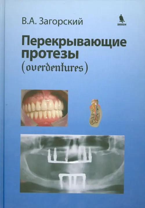 Перекрывающие протезы
