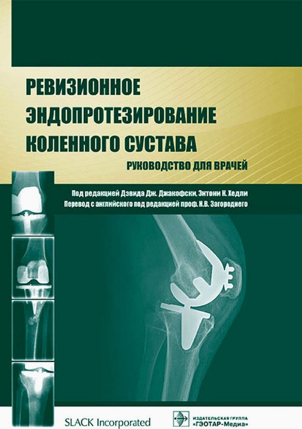 Ревизионное эндопротезирование коленного сустава