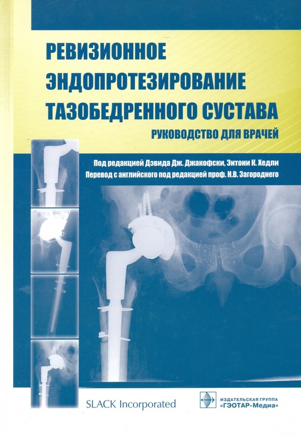 Ревизионное эндопротезирование тазобедренного сустава: Руководство для врачей